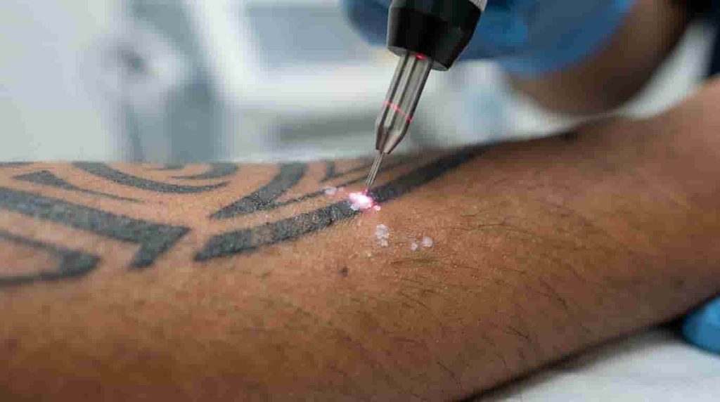 Does Skin Tone Affect Tattoo Removal?