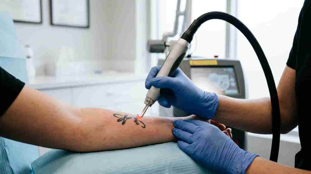 Is Hyper pigmentation After Tattoo Removal Permanent?