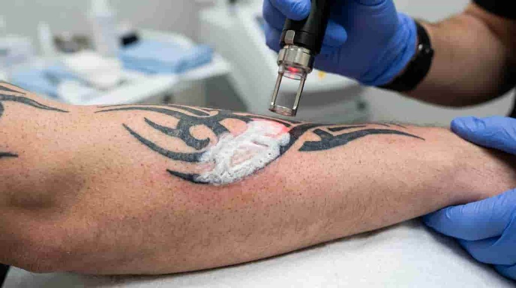 Tattoo Removal Options for Light Skin