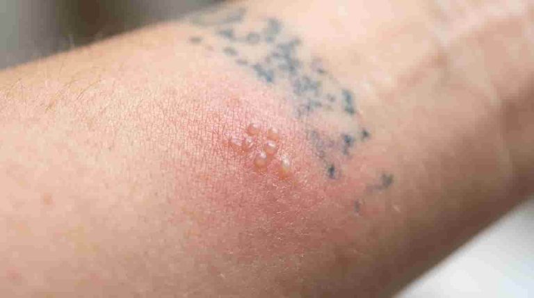 Tattoo Removal Burns: Causes, Symptoms, Treatment and Healing
