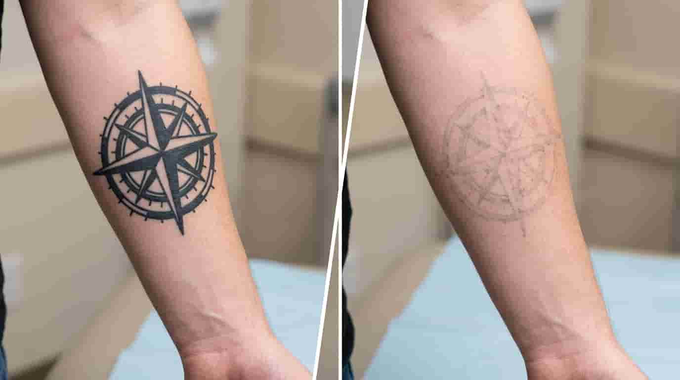 Tattoo Removal for Light Skin: What to Expect and How Well Does It Work?